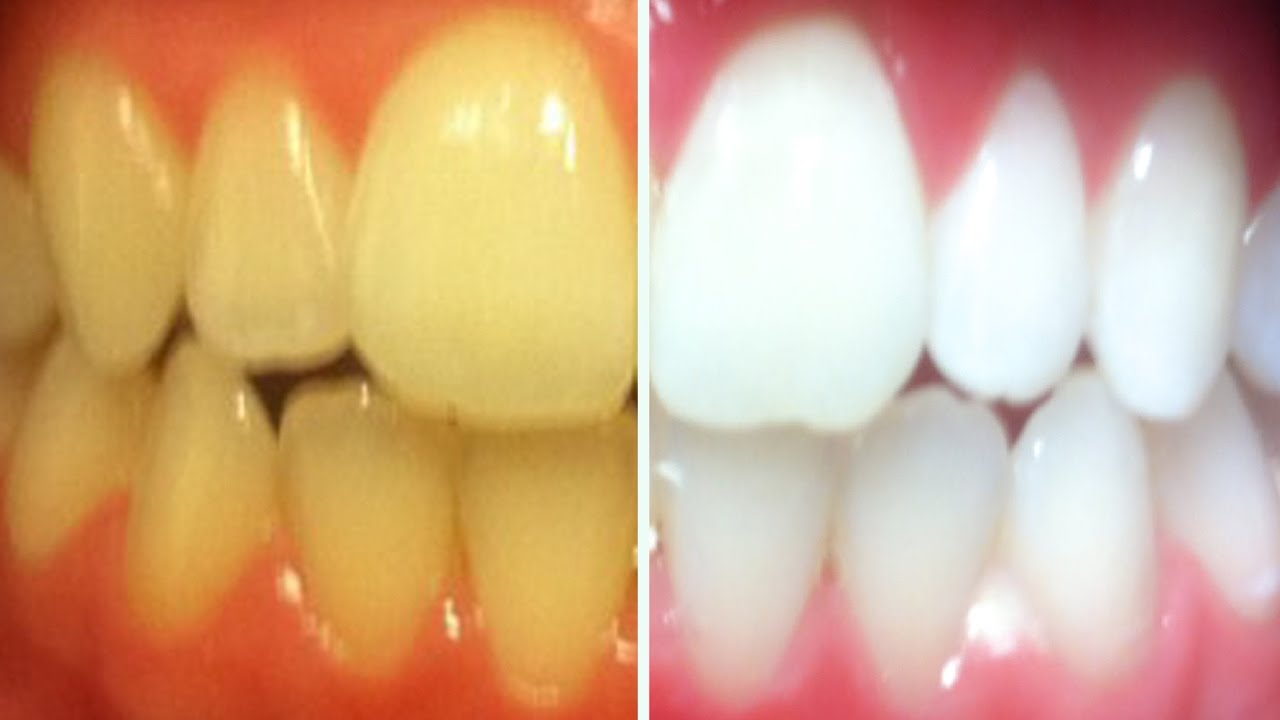 شكل الأسنان بعد تنظيف الجير