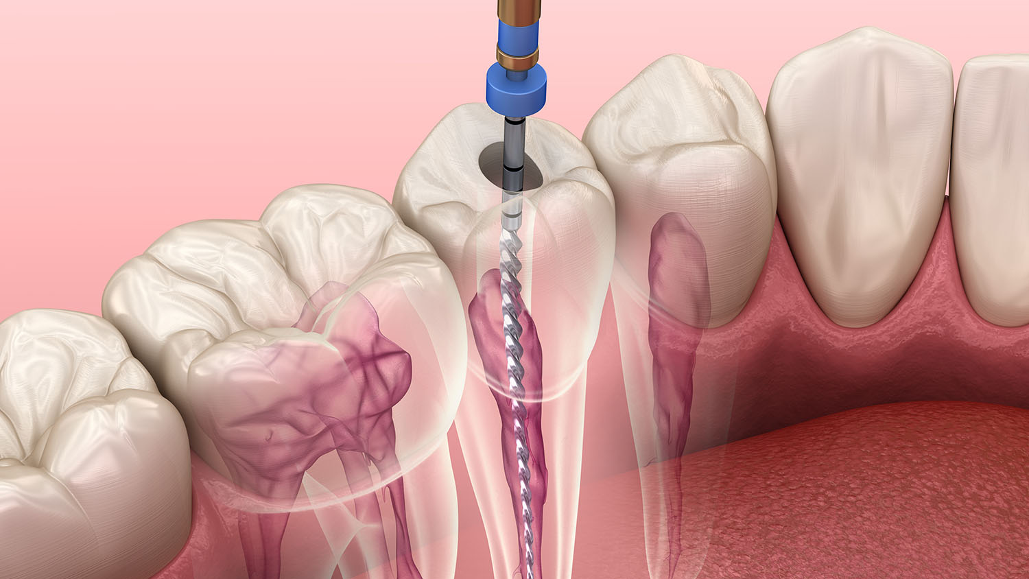 خيارات العلاج للأسنان المخلخلة