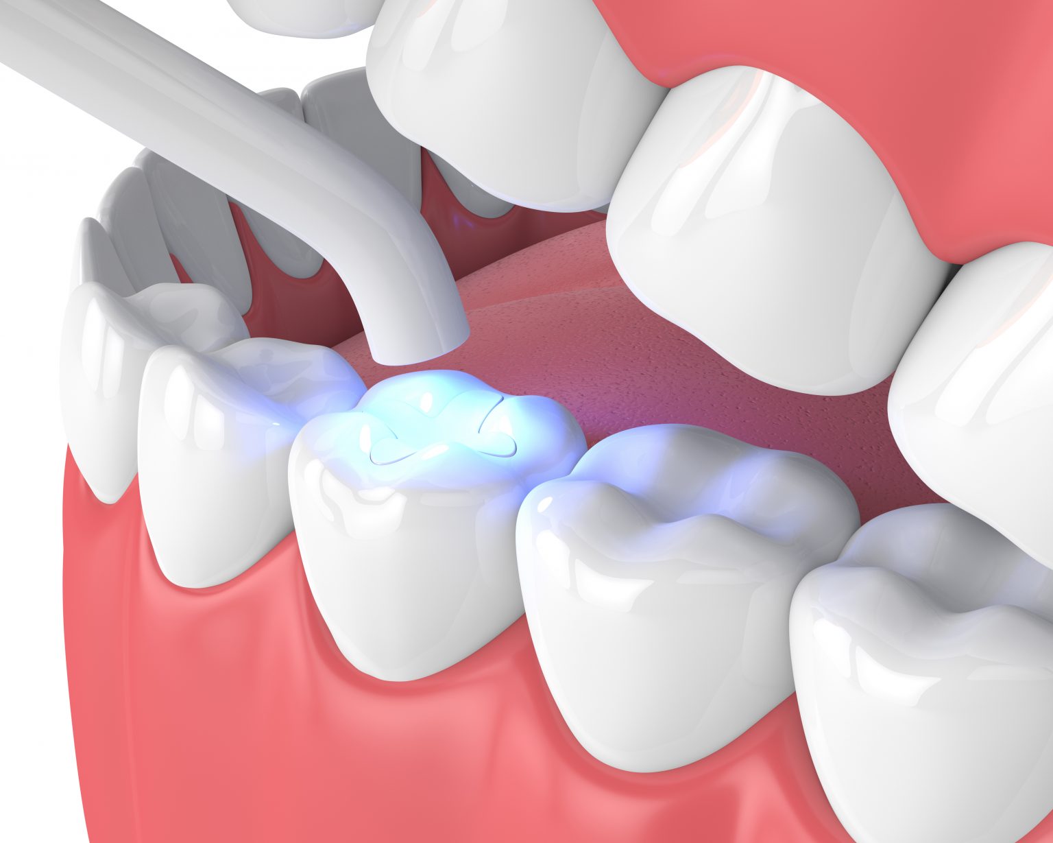 أنواع حشوات الأسنان الدائمة