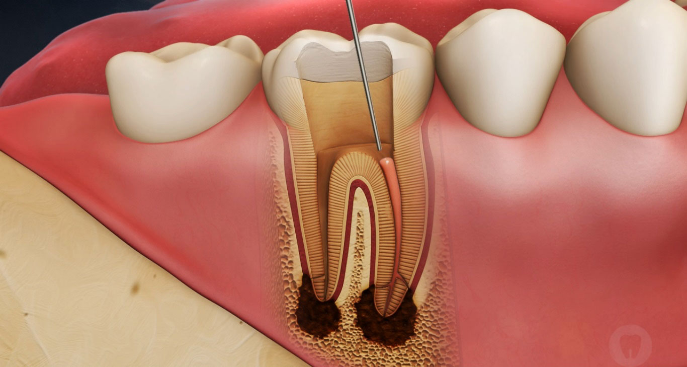 أسباب خلخلة الأسنان عند البالغين