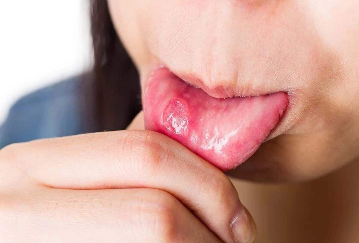  مرض الصدفية في الفم