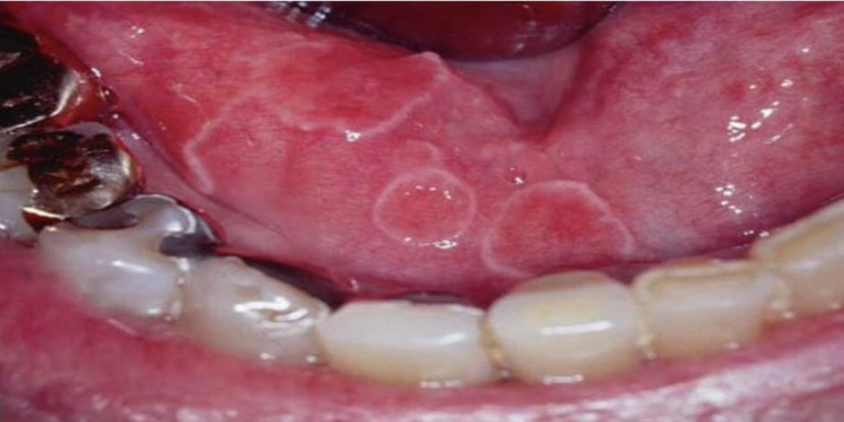 ما هو مرض الصدفية في الفم؟