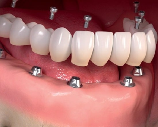 طريقة وكيفية زراعة الأسنان الفورية