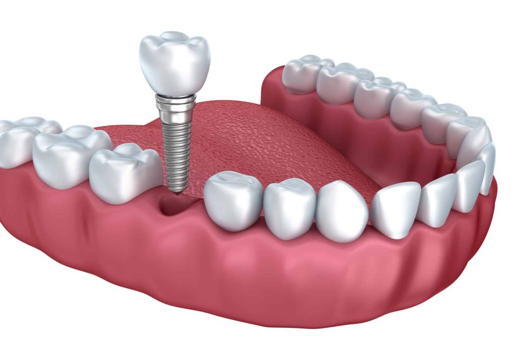 3.Dental Implant 2