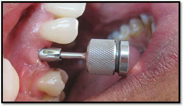 زراعة الأسنان الفورية 
