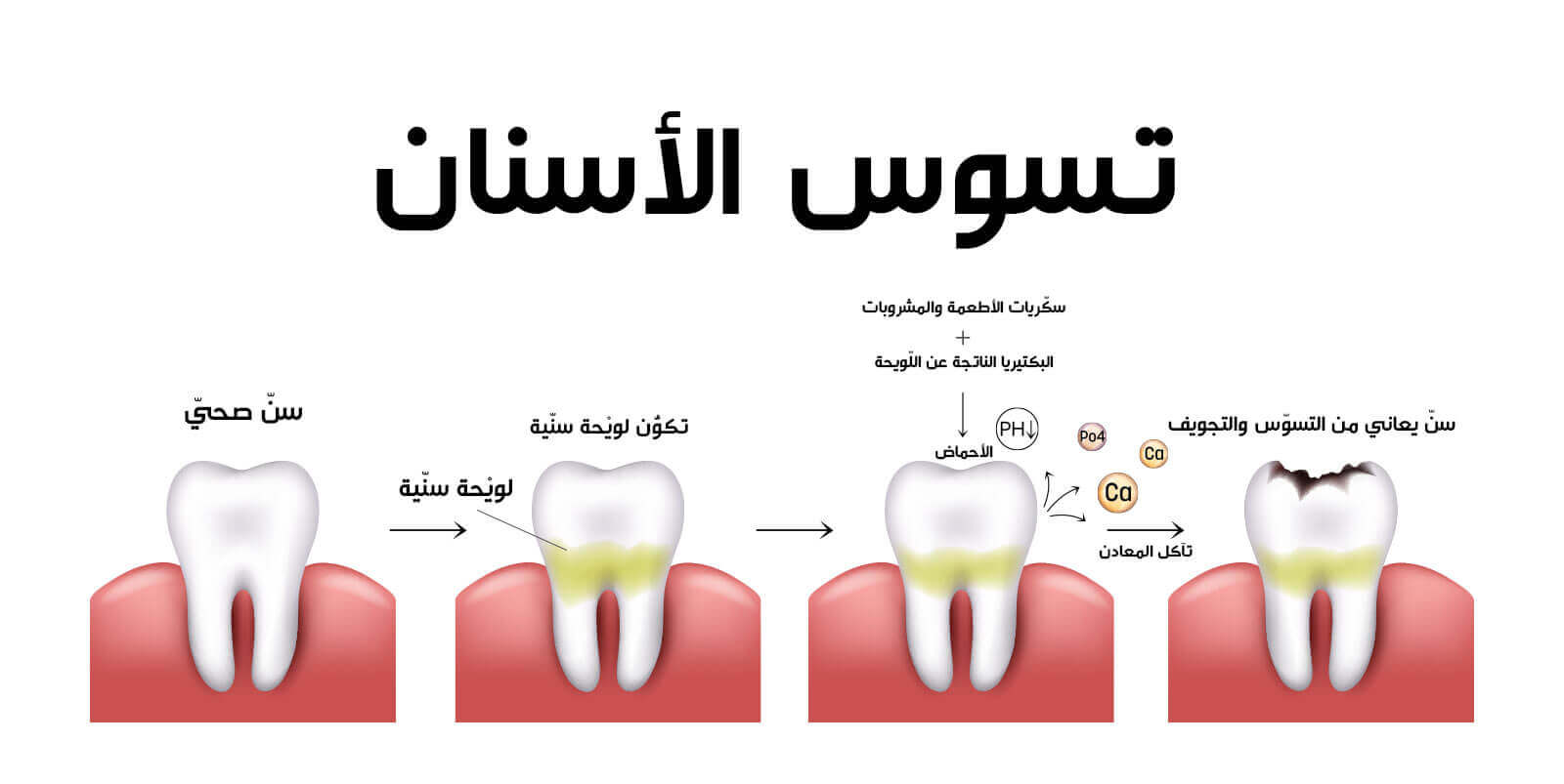 كيف يحدث تسوس الأسنان؟