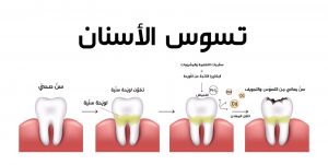 أنواع التسوس الأسنان وعلاجه والأسباب