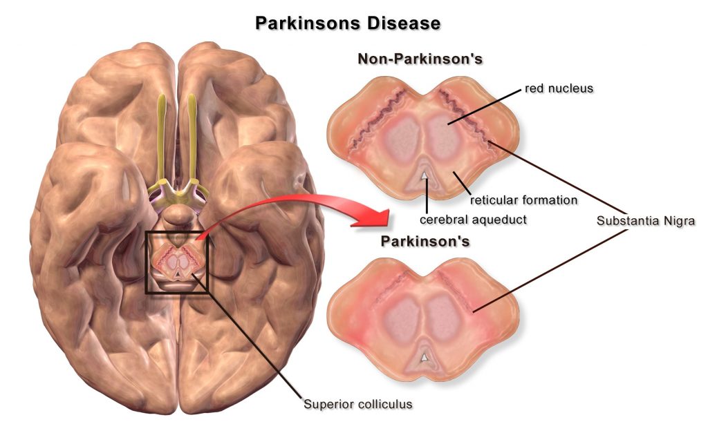 ما هو مرض باركنسون ؟