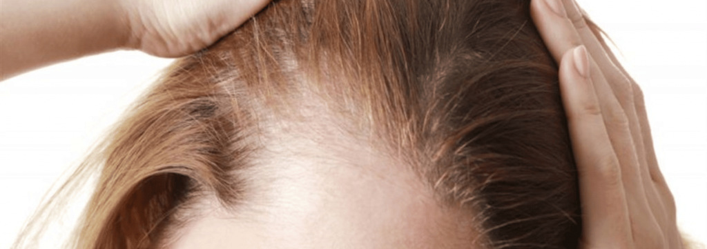 طرق لعلاج الثعلبة وتساقط الشعر