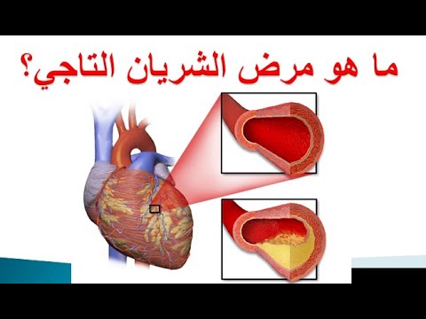 أعراض مرض القلب التاجي 