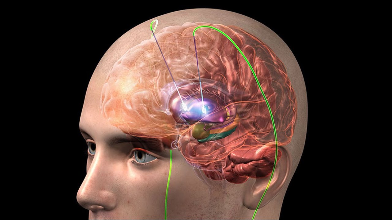 التحفيز العميق للدماغ
