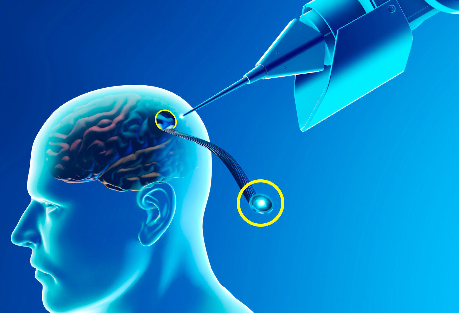 ما هي عملية التحفيز العميق للدماغ