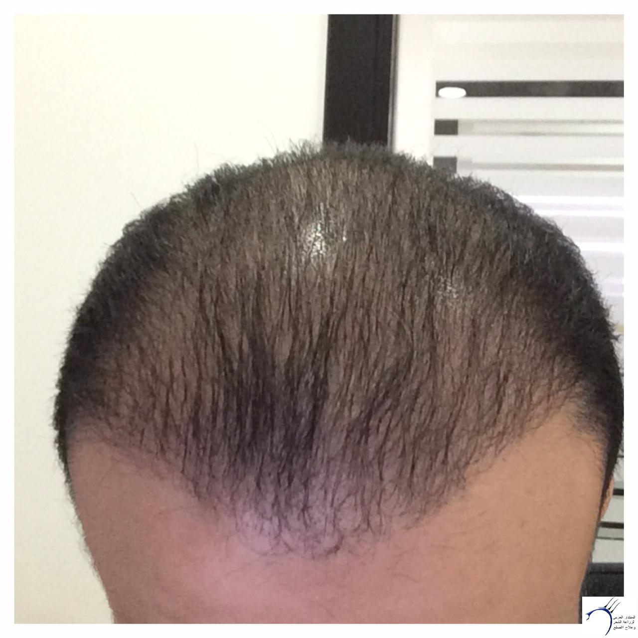 مراحل ما بعد زراعة الشعر