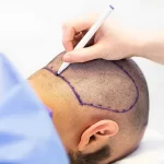 معلومات حول عملية زراعة الشعر