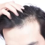 العوامل التي تؤثر على نتائج زراعة الشعر