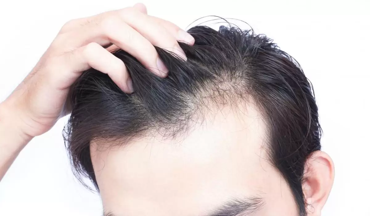 العوامل التي تؤثر على نتائج زراعة الشعر