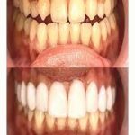 تعرف على زراعة الأسنان الامامية وفوائدها 1