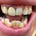 حالات تحتاج إلى بدائل زراعة الأسنان