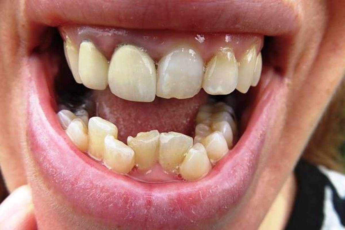 حالات تحتاج إلى بدائل زراعة الأسنان