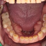 زراعة الأسنان بالغرز الداخلية