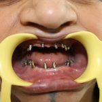 زراعة عظم الأسنان