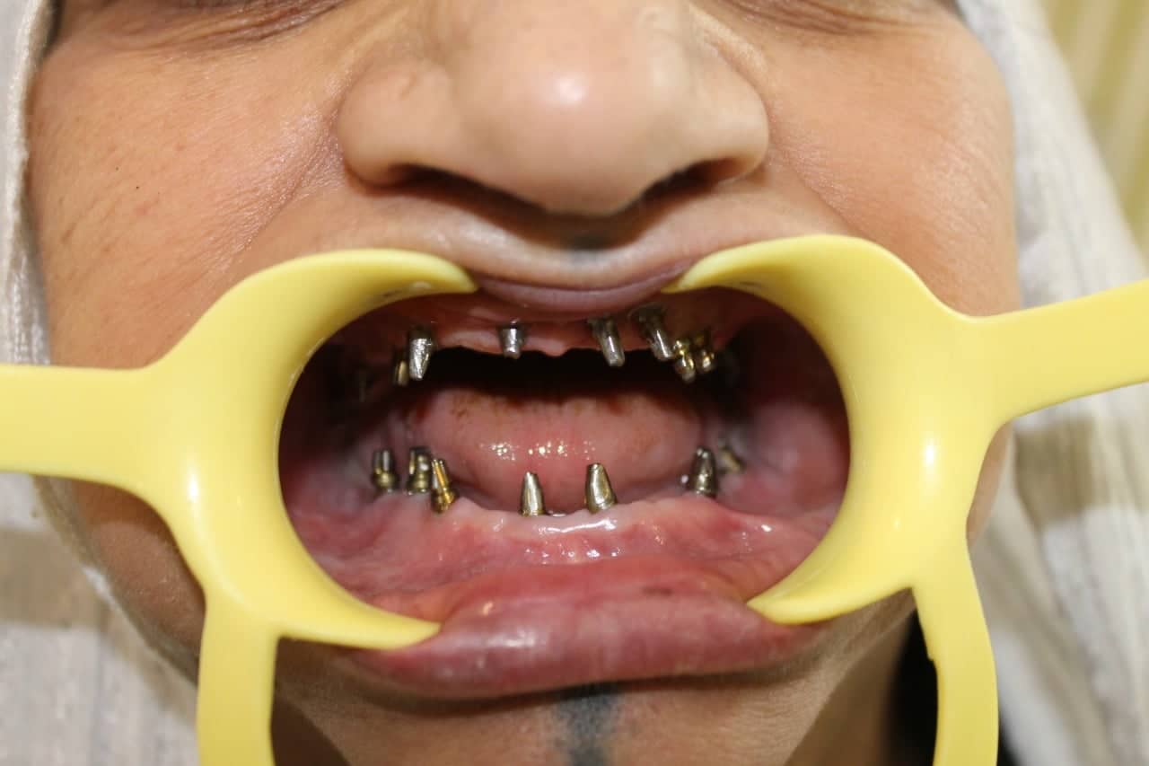 زراعة عظم الأسنان
