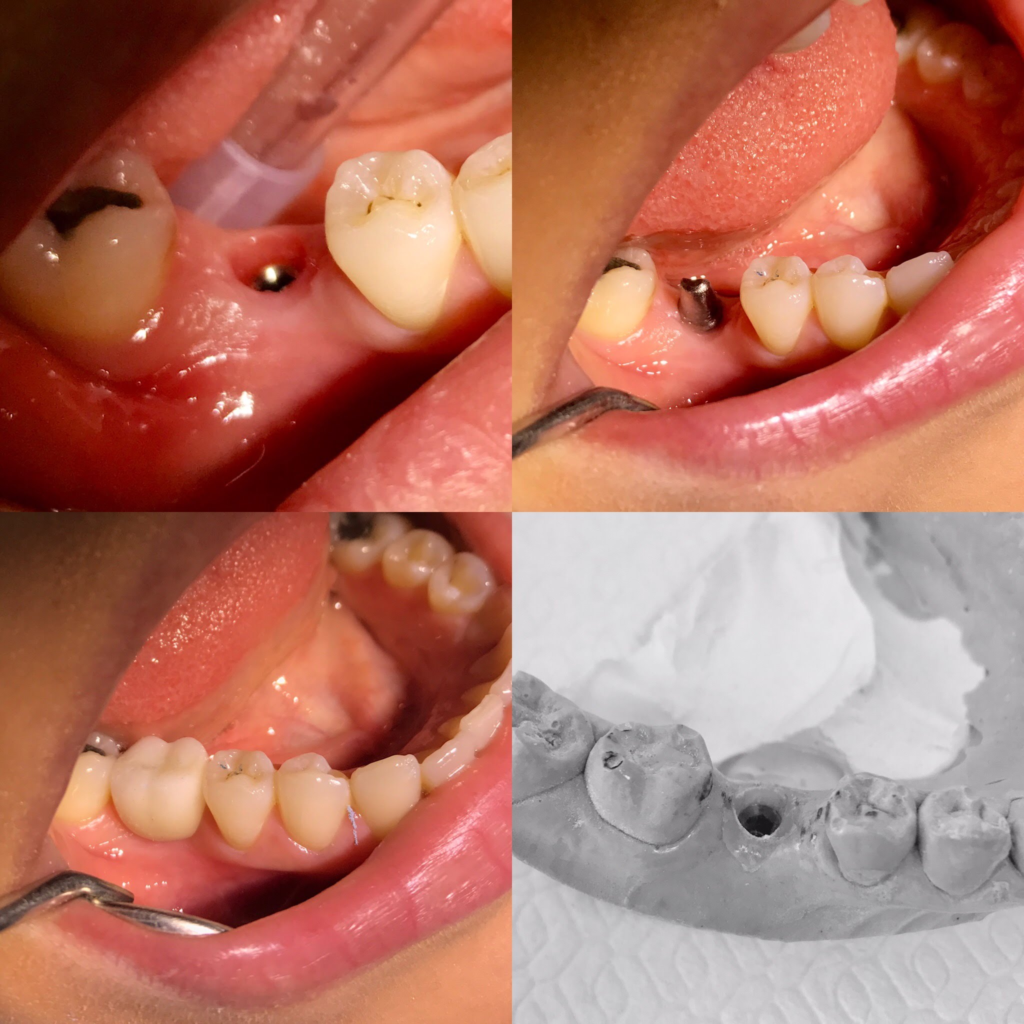 مراحل زراعة الأسنان