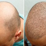 مراحل زراعة الشعر