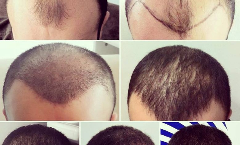مراحل نمو الشعر بعد الزراعة