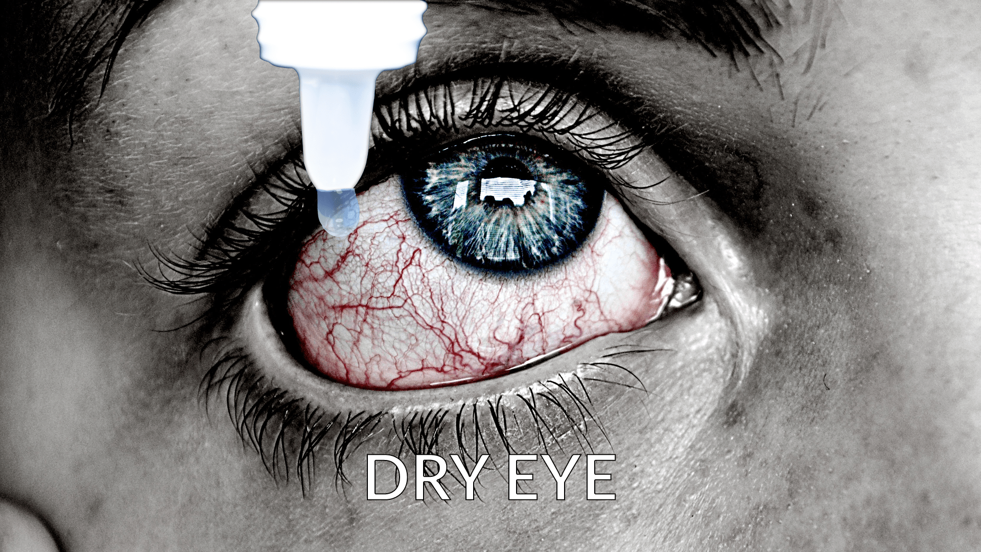 جفاف العين بعد عملية الليزك