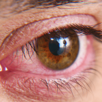 جفاف العين بعد عملية الليزك