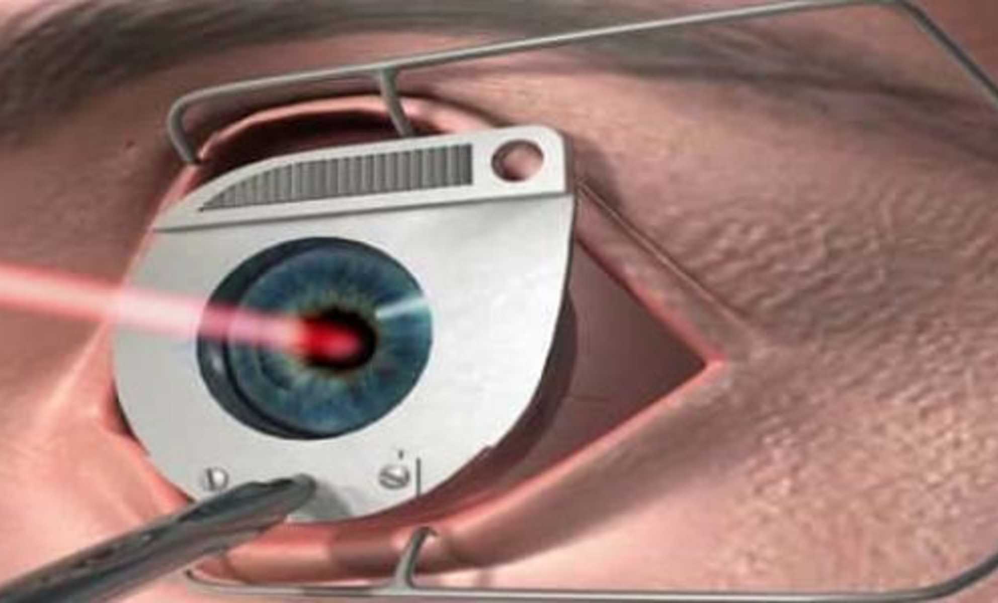 طريقة عملية الليزك للعيون