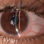 هل عملية الليزك للعيون مؤلمة