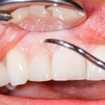 الفرق بين زراعة الأسنان الكوري والالماني 2024
