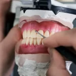 زراعة الأسنان أو التركيب 2024