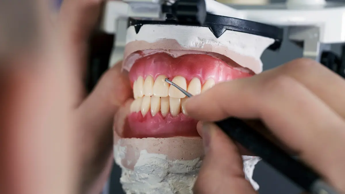 زراعة الأسنان أو التركيب 2024
