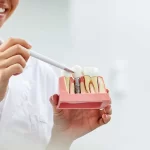 الفرق بين زراعة الأسنان الكوري والالماني 2024