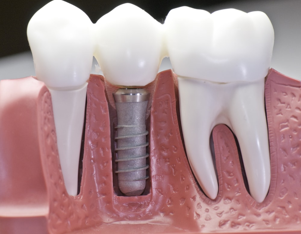 أيهما أفضل زراعة الأسنان أم جسور الأسنان 2024