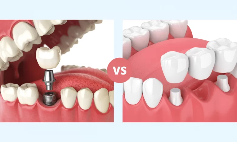 أيهما أفضل زراعة الأسنان أم جسور الأسنان 2024