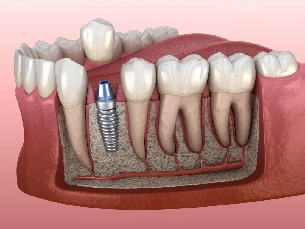 الفرق بين زراعة الأسنان الفورية والتقليدية