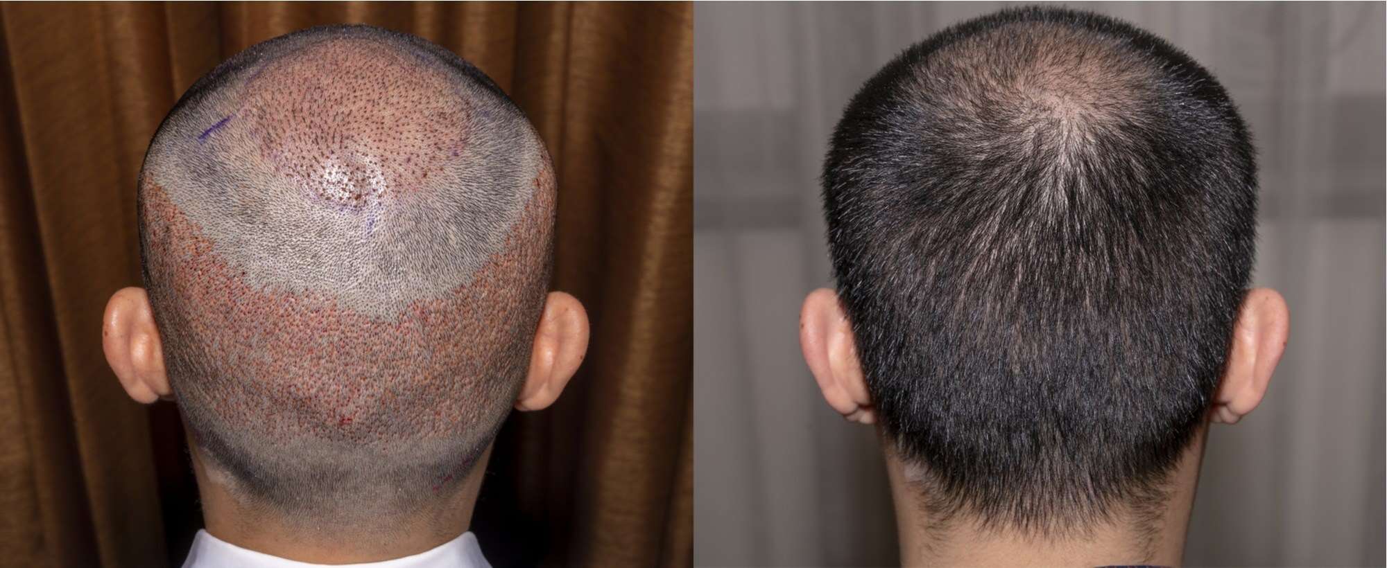 الفرق بين زراعة الشعر في تركيا وقطر