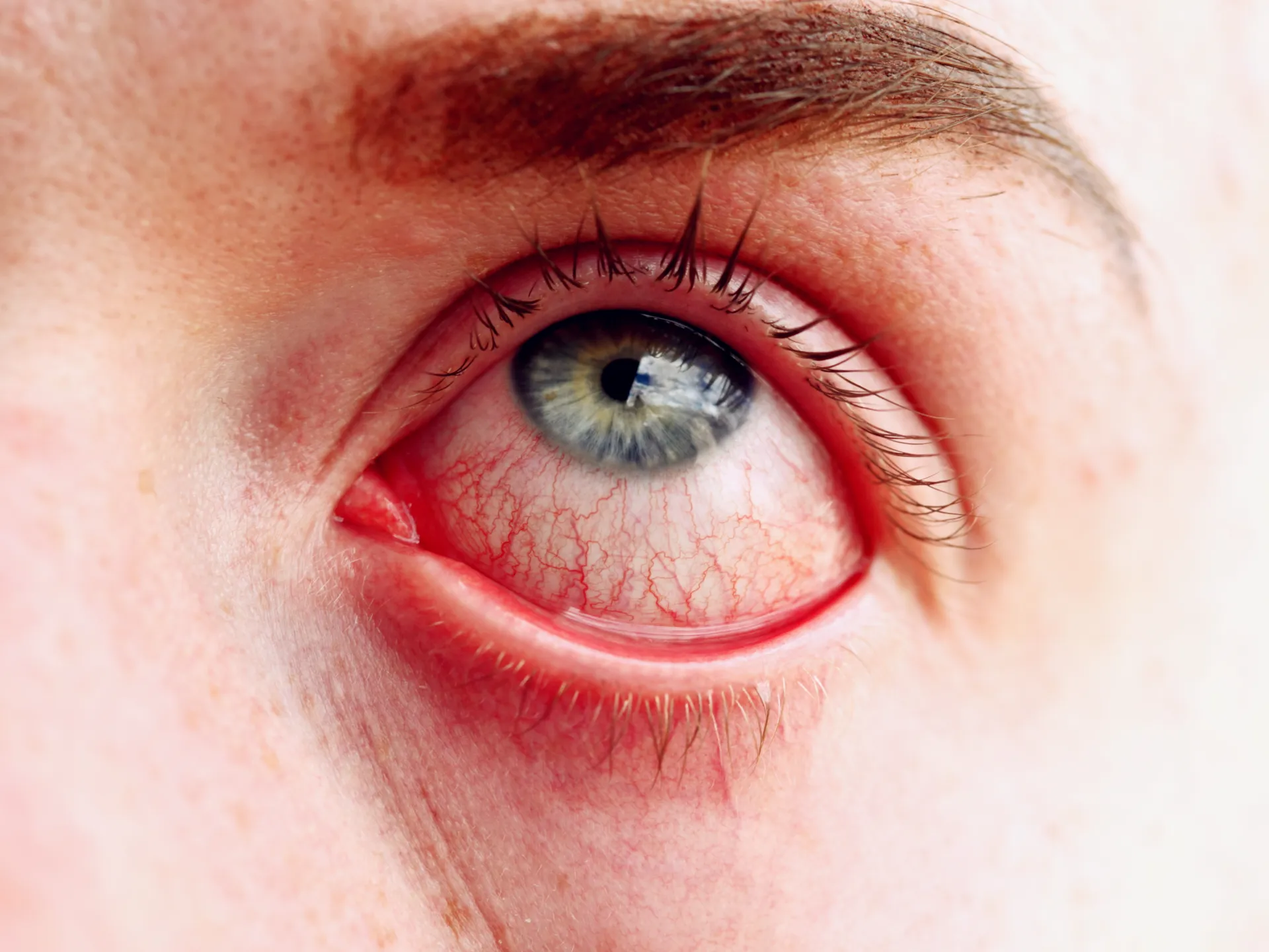 سبب حرقان العين بعد عملية الليزك
