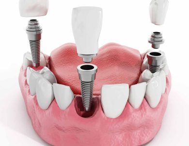ازدادت شهرة عملية زراعة الأسنان Dental implant surgery مؤخرًا بسبب التطور في قطاع طب الأسنان التجميلي واستخدام التقنيات الحديثة في هذا المجال. وكذلك المواد المستخدمة في زراعة الأسنان. لقد أصبح الطلب على هذه العمليات كبيرًا للأشخاص الراغبين في استعادة ابتسامتهم المشرقة. وقد تربعت تركيا على قائمة الدول الرائدة في تقديم زراعة الأسنان والسعودية أيضا من الدول الرائد في مجال زراعة الاسنان. هناك أيضًا عامل الخبرة والكفاءة للأطباء المتخصصين في هذا المجال ، حيث يمكن أن تؤثر خبرتهم ومهاراتهم على التكلفة النهائية للعملية. زراعة الاسنان في تركيا و الكويت7