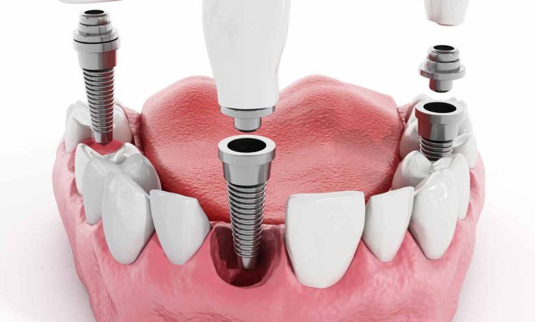 ازدادت شهرة عملية زراعة الأسنان Dental implant surgery مؤخرًا بسبب التطور في قطاع طب الأسنان التجميلي واستخدام التقنيات الحديثة في هذا المجال. وكذلك المواد المستخدمة في زراعة الأسنان. لقد أصبح الطلب على هذه العمليات كبيرًا للأشخاص الراغبين في استعادة ابتسامتهم المشرقة. وقد تربعت تركيا على قائمة الدول الرائدة في تقديم زراعة الأسنان والسعودية أيضا من الدول الرائد في مجال زراعة الاسنان. هناك أيضًا عامل الخبرة والكفاءة للأطباء المتخصصين في هذا المجال ، حيث يمكن أن تؤثر خبرتهم ومهاراتهم على التكلفة النهائية للعملية. زراعة الاسنان في تركيا و الكويت7