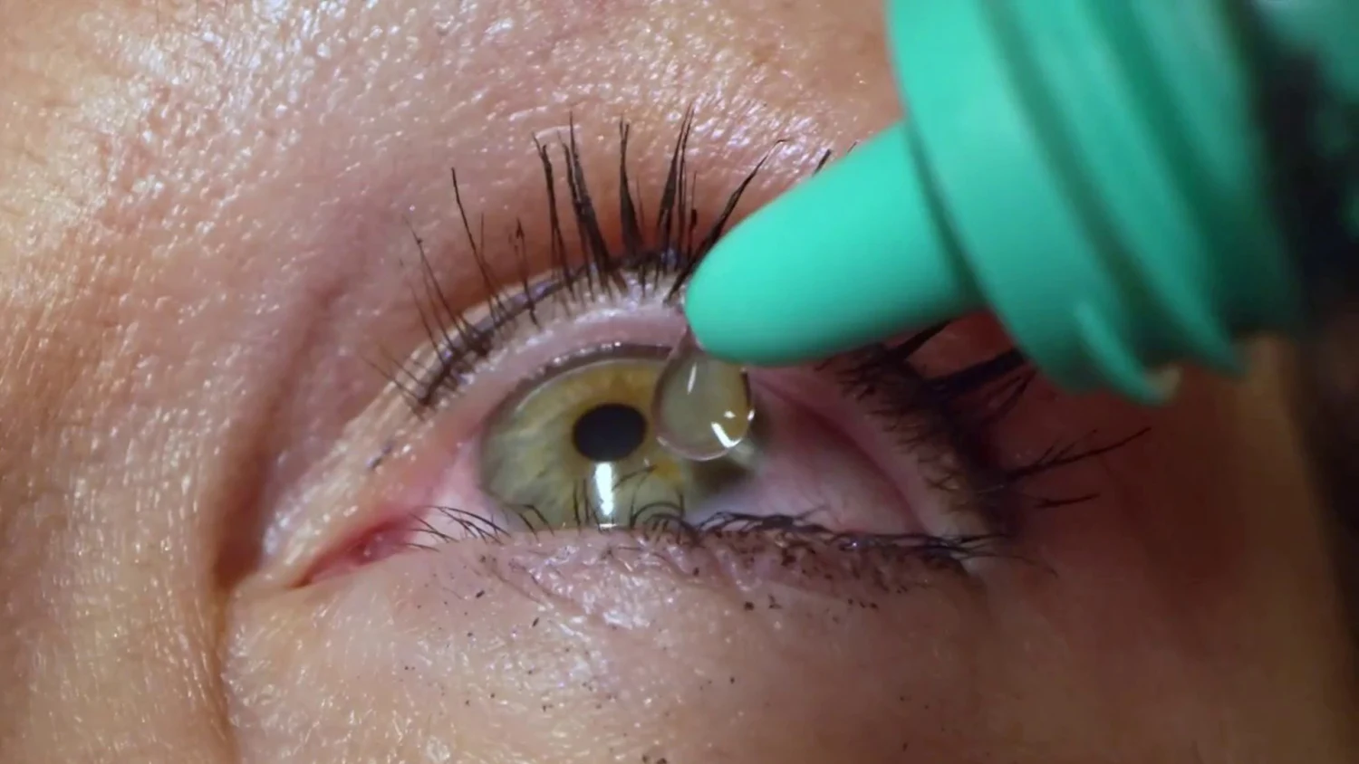 سبب حرقان العين بعد عملية الليزك